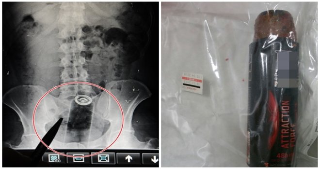 Gaziantep’te Fantezi Deneyen Şahıs Hastanelik Oldu!