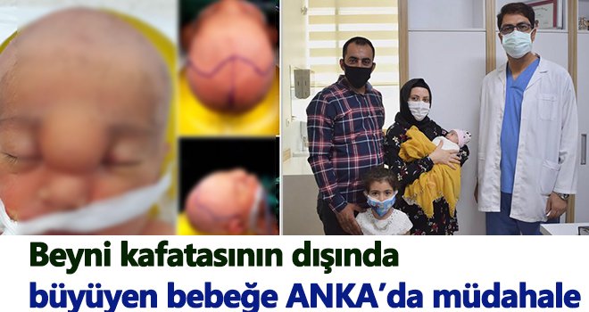 Beyni kafatasının dışında büyüyen bebek ANKA’da sağlığına kavuştu