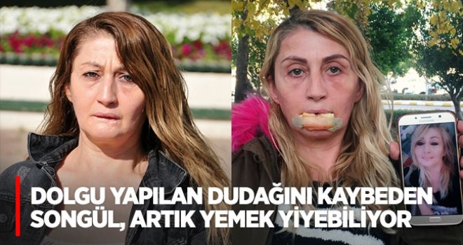 Dolgu yapılan dudağını kaybeden Songül, artık yemek yiyebiliyor