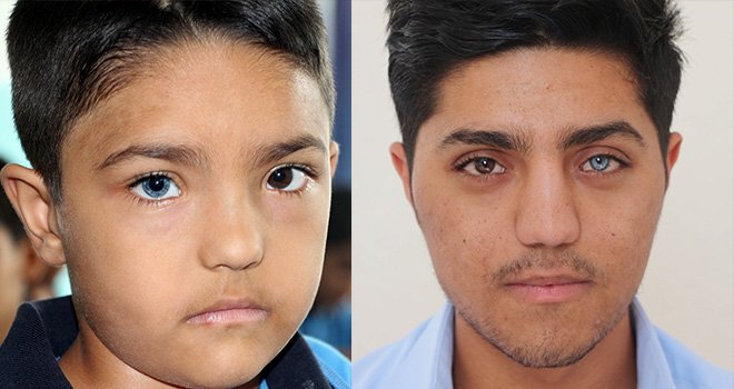 Gaziantep'te Bir gözü mavi, diğeri kahverengi kardeşler şaşırtıyor