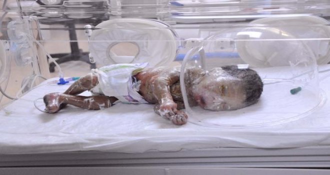 Gaziantep'te 'Palyaço bebek' yaşam mücadelesi veriyor