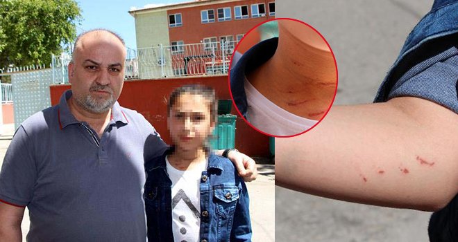 Gaziantep'te,13 yaşındaki kızı dövüldüğü iddiasıyla şikayetçi oldu