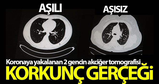 Koronaya yakalanan 2 genç hastanın akciğer tomografisi karşılaştırıldı
