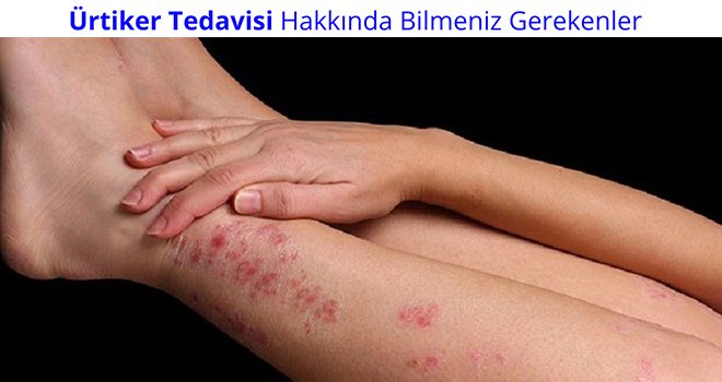 KURDEŞEN NEDİR VE TEDAVİSİ NASILDIR?