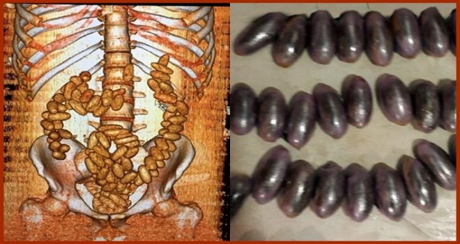 Midelerinde 317 prezervatif içinde 3 kilo esrar ele geçirildi